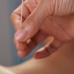 2 Manfaat Terapi Akupuntur Usai Serangan Stroke, Bisa Cegah Kecacatan?