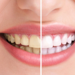 Cara Mengatasi Gigi Kuning